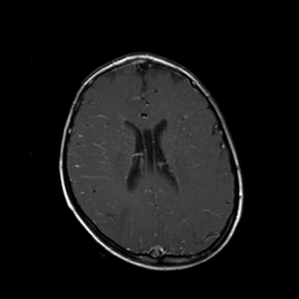 File:Cerebral tuberculoma (Radiopaedia 41152-43932 Axial T1 C+ 14).jpg