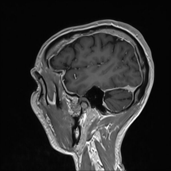 File:Cervical dural CSF leak on MRI and CT treated by blood patch (Radiopaedia 49748-54995 G 102).jpg