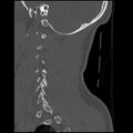 Cervical flexion teardrop fracture with cord hemorrhage (Radiopaedia 32497-33454 Sagittal bone window 37).jpg