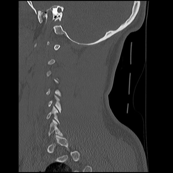 File:Cervical flexion teardrop fracture with cord hemorrhage (Radiopaedia 32497-33454 Sagittal bone window 37).jpg