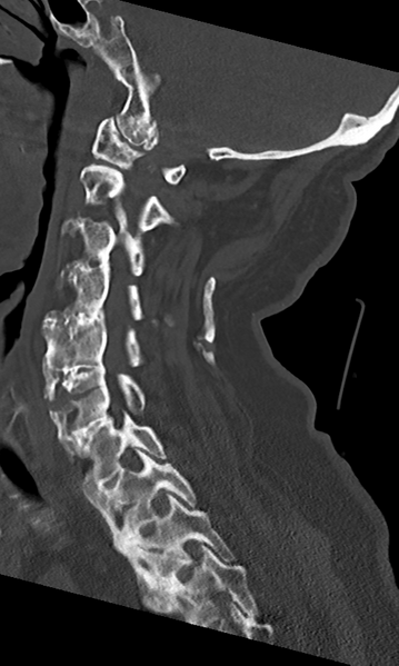 File:Cervical spine fracture - chalk stick (Radiopaedia 39116-41323 Sagittal bone window 36).png