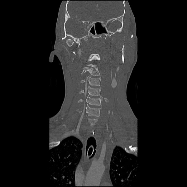 File:Cervical spine fractures with vertebral artery dissection (Radiopaedia 32135-33078 Coronal bone window 6).jpg