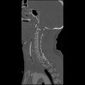 Cervical spine fractures with vertebral artery dissection (Radiopaedia 32135-33078 Sagittal bone window 25).jpg