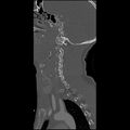 Cervical spine fractures with vertebral artery dissection (Radiopaedia 32135-33078 Sagittal bone window 30).jpg