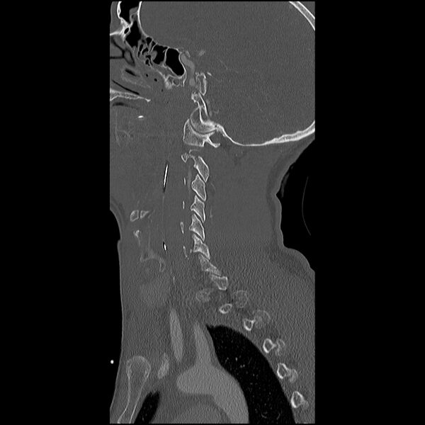 File:Cervical spine fractures with vertebral artery dissection (Radiopaedia 32135-33078 Sagittal bone window 30).jpg