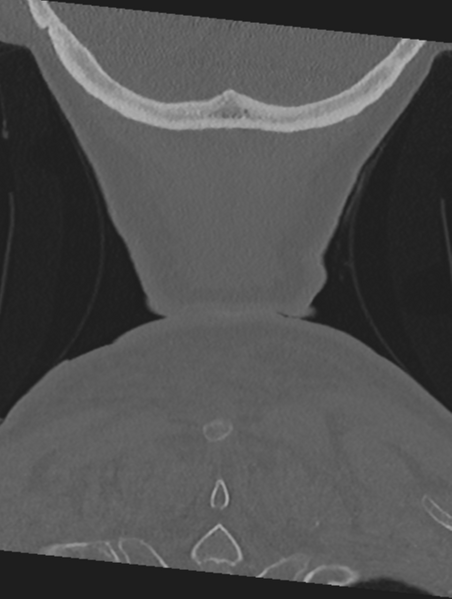 File:Cervical spondylolysis (Radiopaedia 49616-54811 Coronal bone window 63).png