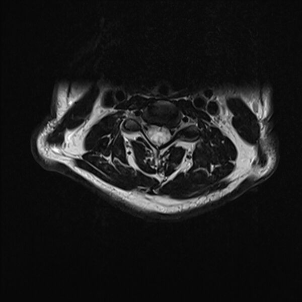 File:Cervical tumor-like myelopathy due to Type V dAVF (Radiopaedia 82461-96604 Axial T2 15).jpg