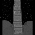 Chance fracture (Radiopaedia 36521-38081 Coronal bone window 27).jpg