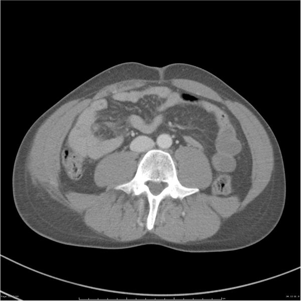 File:Chest and abdomen multi-trauma (Radiopaedia 26294-26426 bone window 52).jpg