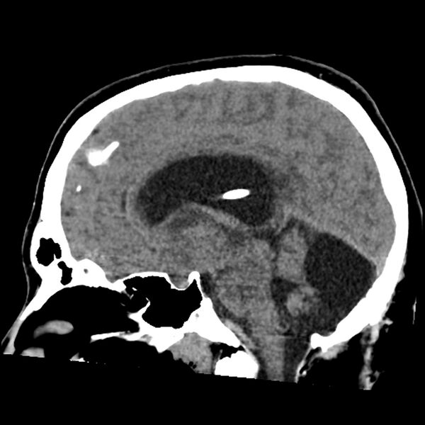 File:Chiasmatic-hypothalamic juvenile pilocytic astrocytoma (Radiopaedia 78533-91237 B 34).jpg