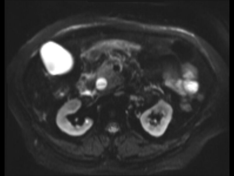 File:Choledocholithiasis causing intrahepatic biliary duct dilation (Radiopaedia 39908-42369 Axial T2 SPAIR 11).jpg