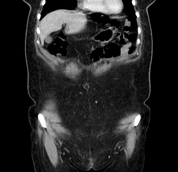 File:Choledocholithiasis on CT and MRI (Radiopaedia 24825-25087 C 12).jpg