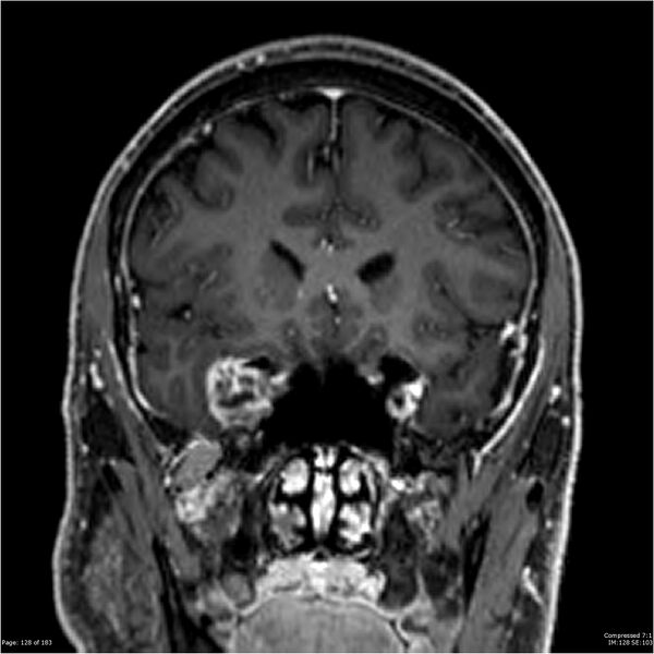 File:Chondrosarcoma of skull base- grade II (Radiopaedia 40948-43654 Coronal T1 C+ 39).jpg