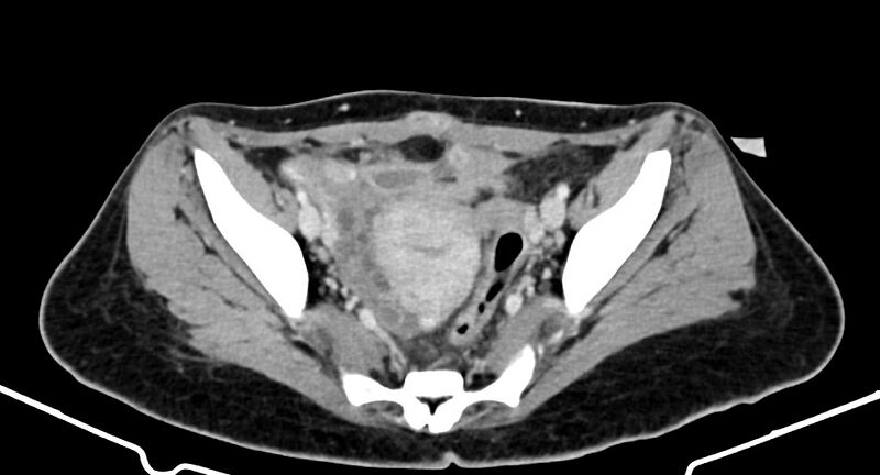 File:Choriocarcinoma liver metastases (Radiopaedia 74768-85766 A 173).jpg