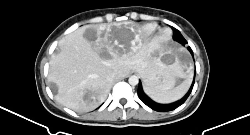 File:Choriocarcinoma liver metastases (Radiopaedia 74768-85766 A 38).jpg