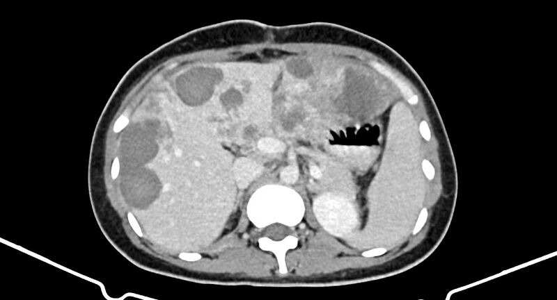 File:Choriocarcinoma liver metastases (Radiopaedia 74768-85766 A 73).jpg