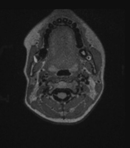 File:Choroid plexus carcinoma (Radiopaedia 91013-108553 Axial FLAIR C+ 43).jpg