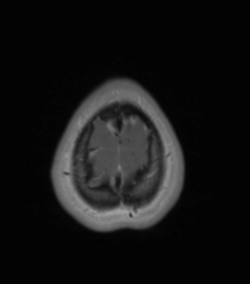 Choroid plexus carcinoma (Radiopaedia 91013-108553 Axial T1 C+ 199).jpg