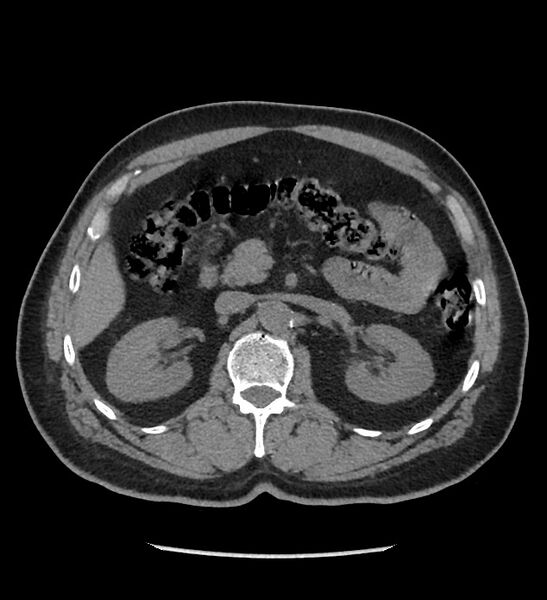 File:Chromophobe renal cell carcinoma (Radiopaedia 86879-103083 Axial non-contrast 34).jpg