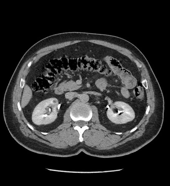 File:Chromophobe renal cell carcinoma (Radiopaedia 86879-103083 D 57).jpg
