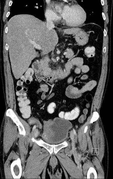 File:Chronic appendicitis complicated by appendicular abscess, pylephlebitis and liver abscess (Radiopaedia 54483-60700 C 36).jpg