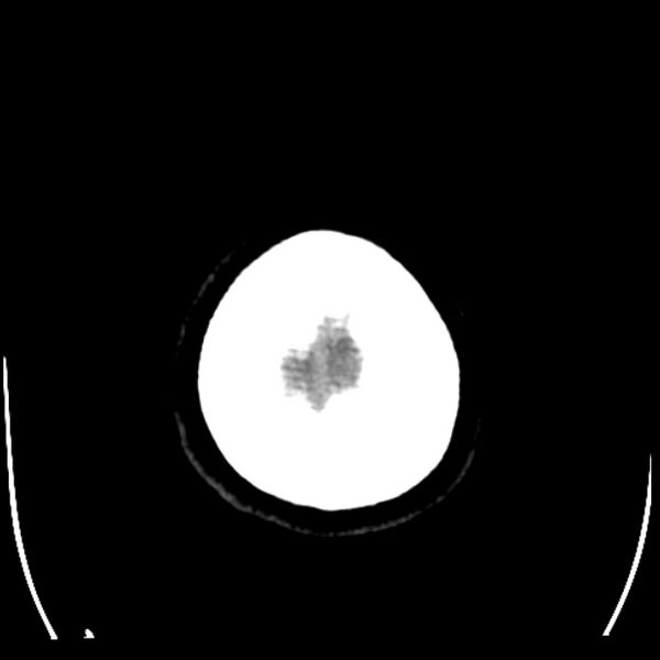 File:Chronic bilateral occipital lobe infarcts (Radiopaedia 31276-31996 Axial non-contrast 42).jpg