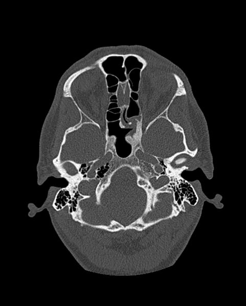 File:Chronic maxillary sinusitis caused by a foreign body (Radiopaedia 58521-65676 Axial bone window 221).jpg