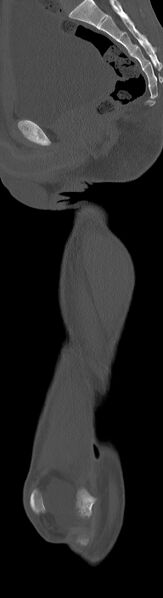 File:Chronic osteomyelitis (with sequestrum) (Radiopaedia 74813-85822 C 59).jpg