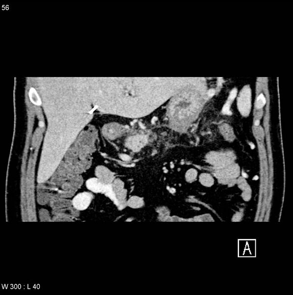 File:Chronic pancreatitis and pseudocysts (Radiopaedia 6724-7935 C 2).jpg