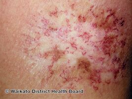 Chronic radiation dermatitis