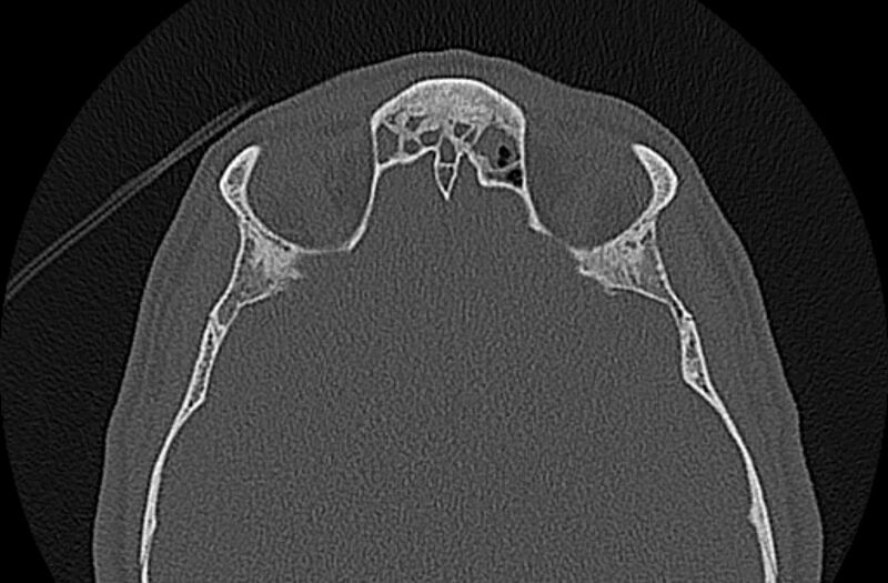 File:Chronic rhinosinusitis (Radiopaedia 65079-74075 Axial bone window 68).jpg