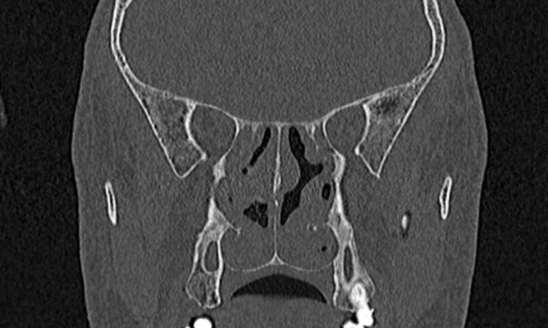 File:Chronic rhinosinusitis (Radiopaedia 65079-74075 Coronal bone window 54).jpg