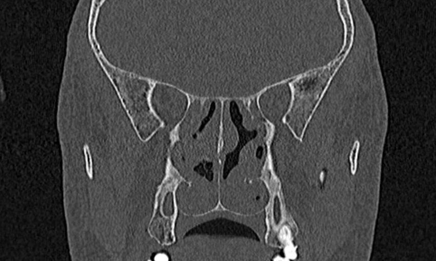 Chronic rhinosinusitis (Radiopaedia 65079-74075 Coronal bone window 54).jpg