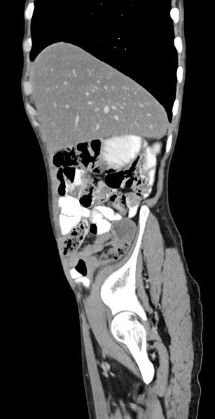 File:Chronic small bowel volvulus (Radiopaedia 75224-86322 C 117).jpg