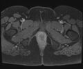 Class II Mullerian duct anomaly- unicornuate uterus with rudimentary horn and non-communicating cavity (Radiopaedia 39441-41755 Axial T1 fat sat 141).jpg