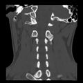 Clay-shoveler fracture (Radiopaedia 22568-22590 Coronal bone window 22).jpg