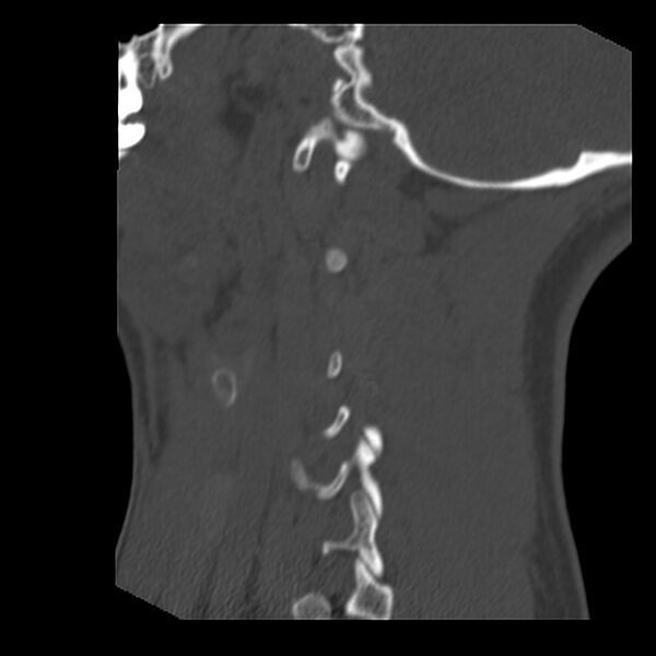File:Clay-shoveler fracture (Radiopaedia 22568-22590 Sagittal bone window 40).jpg