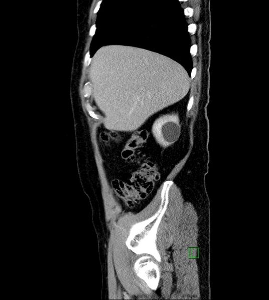File:Clear cell renal cell carcinoma (Radiopaedia 85006-100539 G 51).jpg