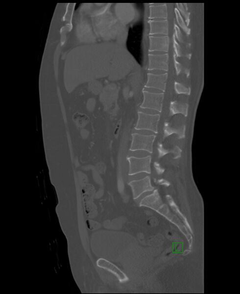 File:Clear cell renal cell carcinoma (Radiopaedia 85006-100539 Sagittal bone window 32).jpg