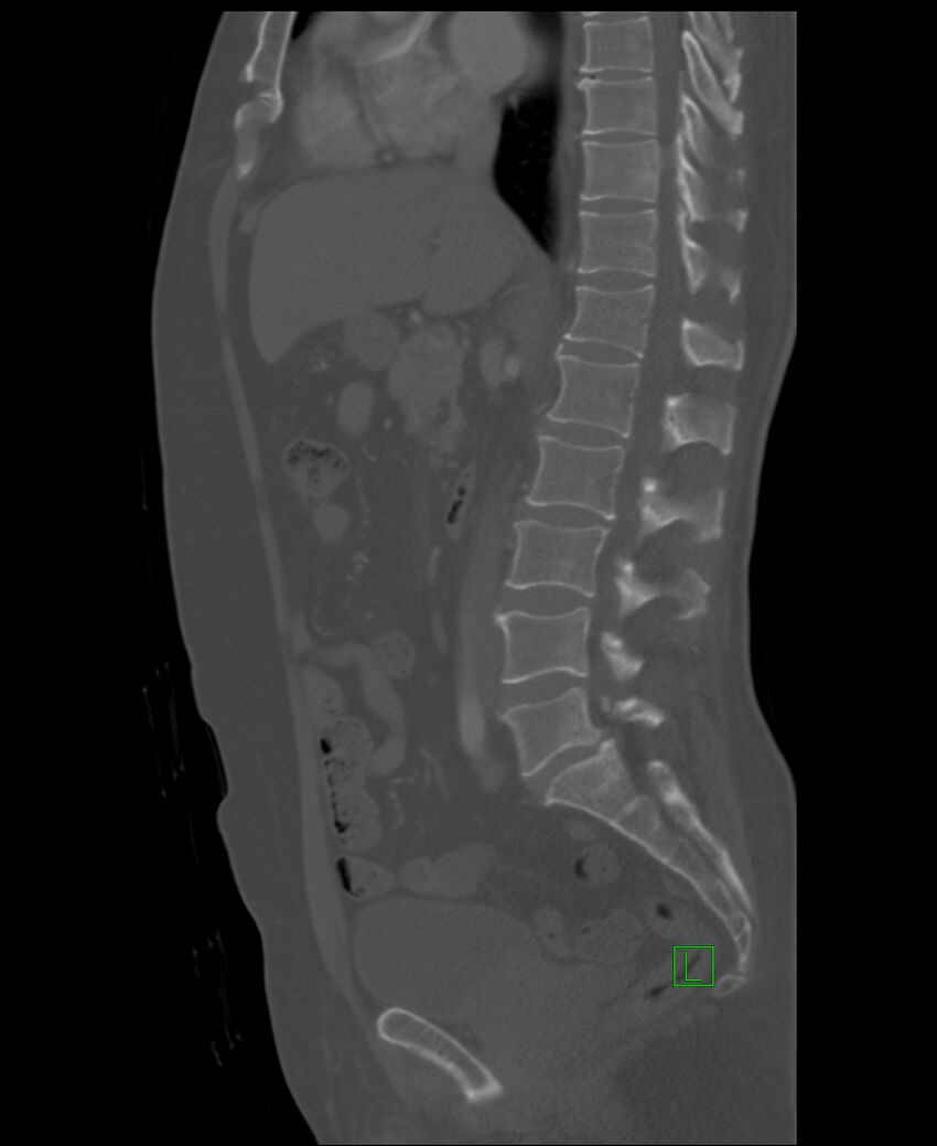 Clear cell renal cell carcinoma (Radiopaedia 85006-100539 Sagittal bone window 32).jpg