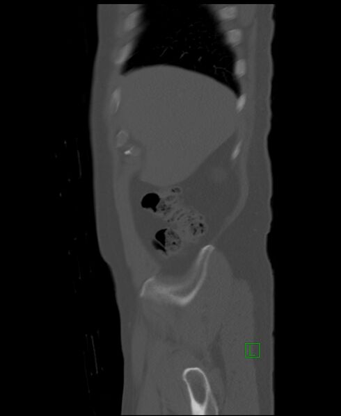 File:Clear cell renal cell carcinoma (Radiopaedia 85006-100539 Sagittal bone window 53).jpg