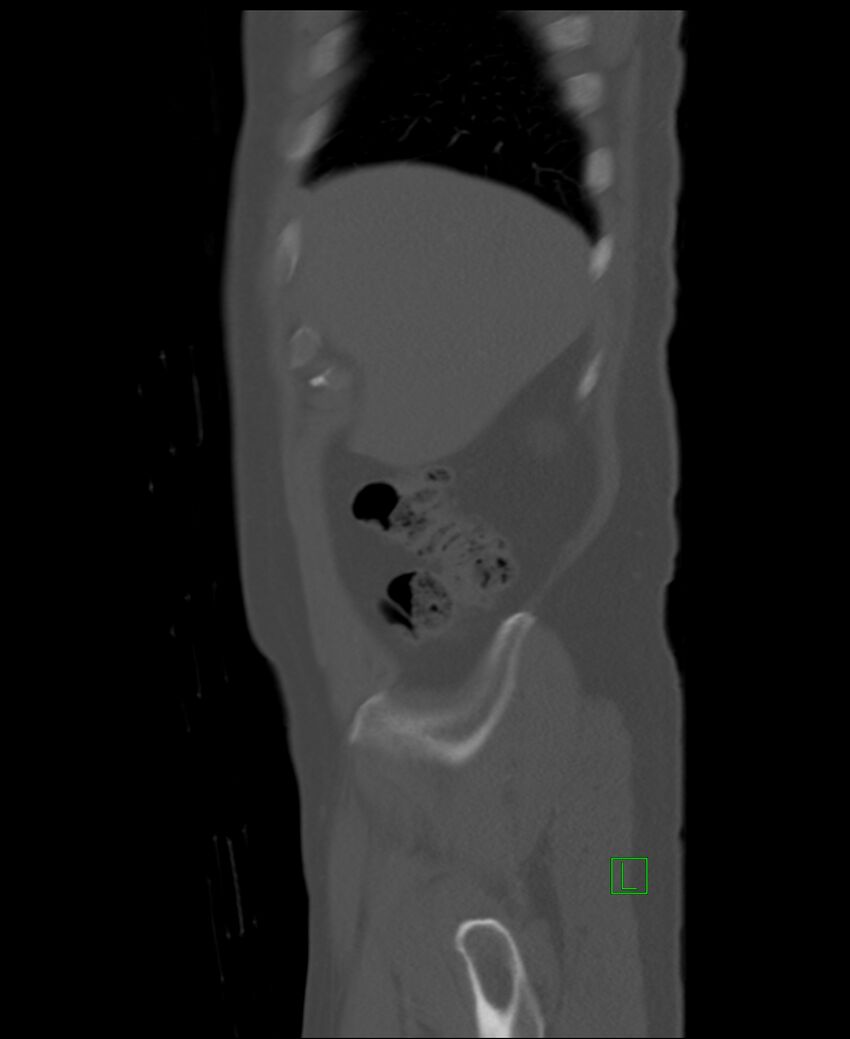 Clear cell renal cell carcinoma (Radiopaedia 85006-100539 Sagittal bone window 53).jpg