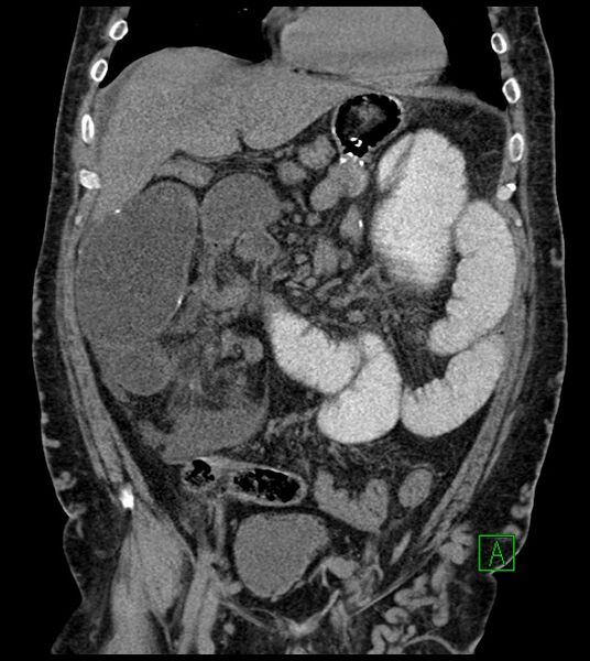 File:Closed-loop small bowel obstruction-internal hernia (Radiopaedia 78439-91096 Coronal non-contrast 40).jpg