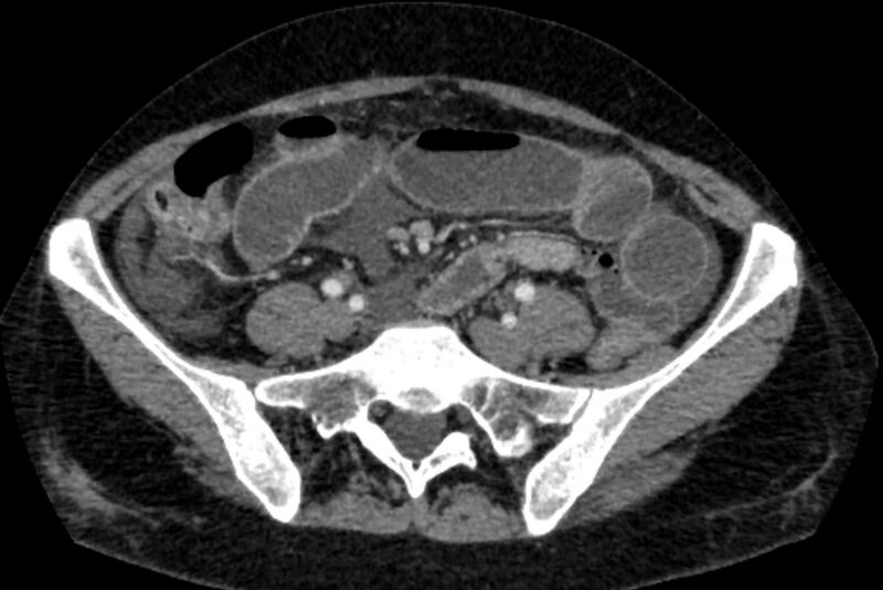 File:Closed loop small bowel obstruction (Radiopaedia 71211-81508 A 100).jpg