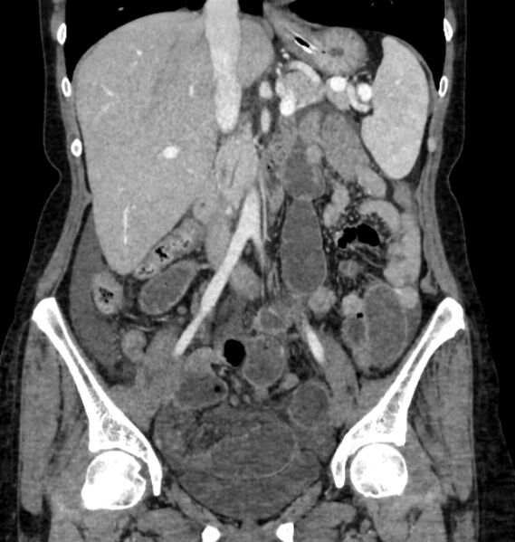 File:Closed loop small bowel obstruction (Radiopaedia 71211-81508 B 55).jpg