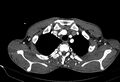 Coarctation of aorta with aortic valve stenosis (Radiopaedia 70463-80574 A 2).jpg