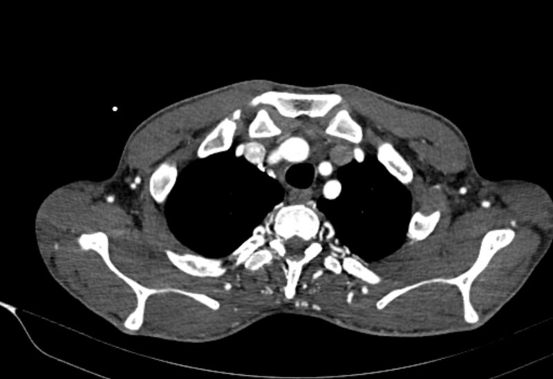 File:Coarctation of aorta with aortic valve stenosis (Radiopaedia 70463-80574 A 2).jpg