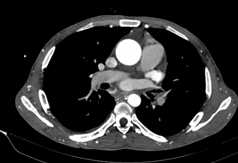 File:Coarctation of aorta with aortic valve stenosis (Radiopaedia 70463-80574 A 89).jpg