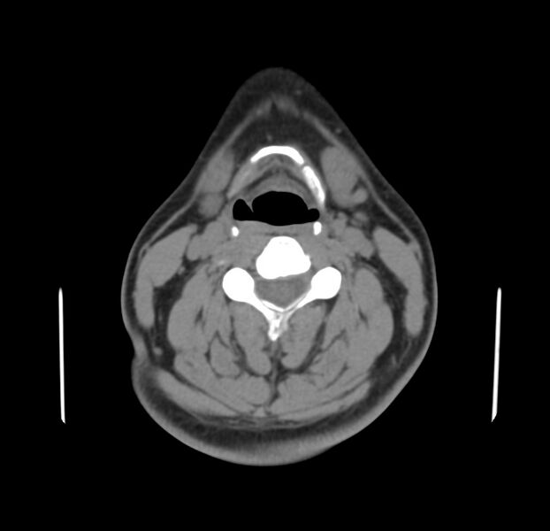 File:Colloid cyst of thyroid (Radiopaedia 22897-22923 Axial non-contrast 26).jpg