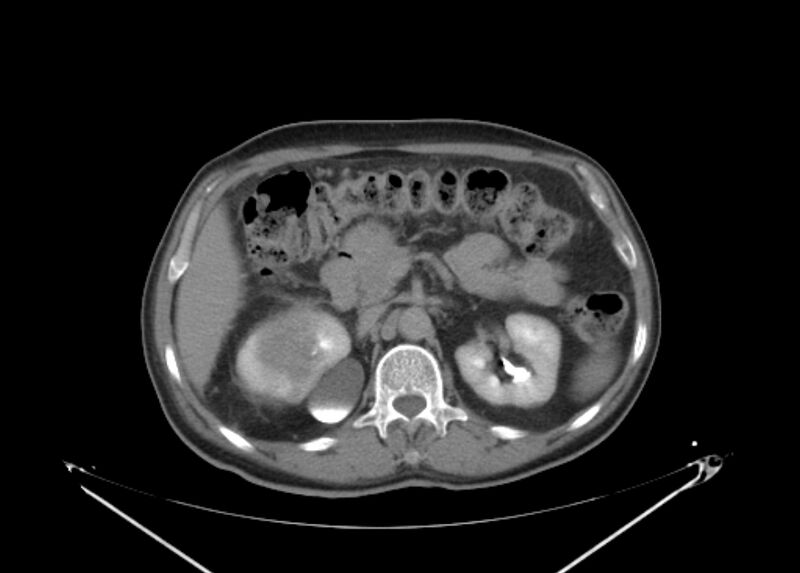 File:Colon cancer mimicking renal cell carcinoma (Radiopaedia 28986-29335 Axial C+ delayed 26).jpg